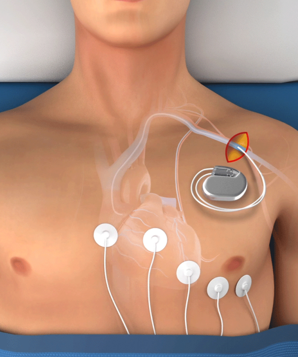 Permanent Pacemaker Surgery